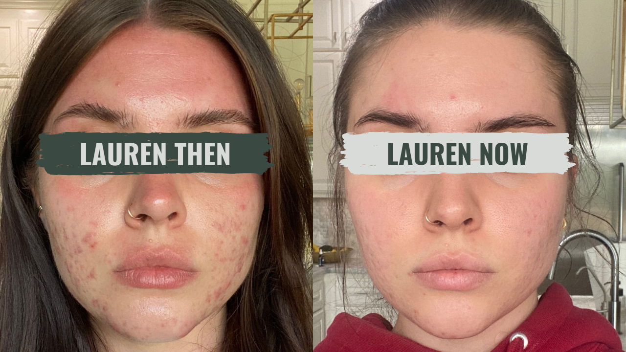 Lauren's skin, then and now