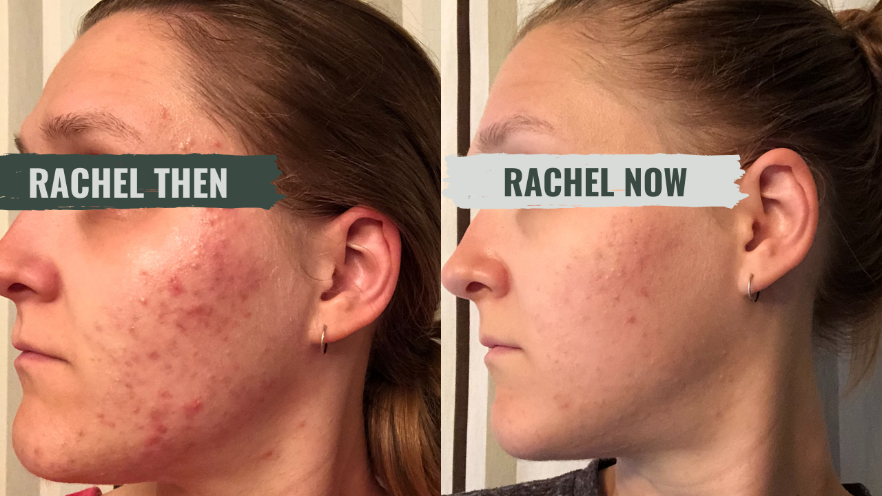 Rachel's skin, then and now