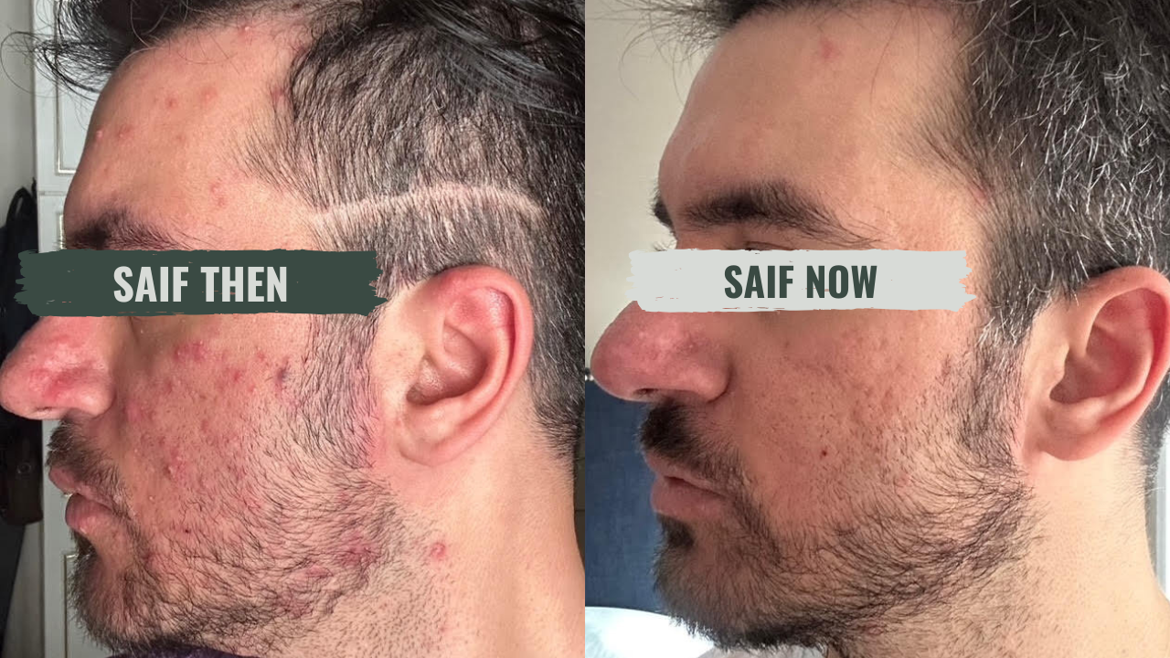 Saif's skin, then and now