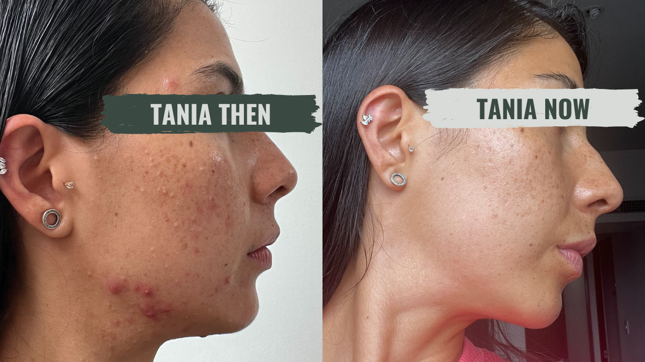 Tania's skin, then and now