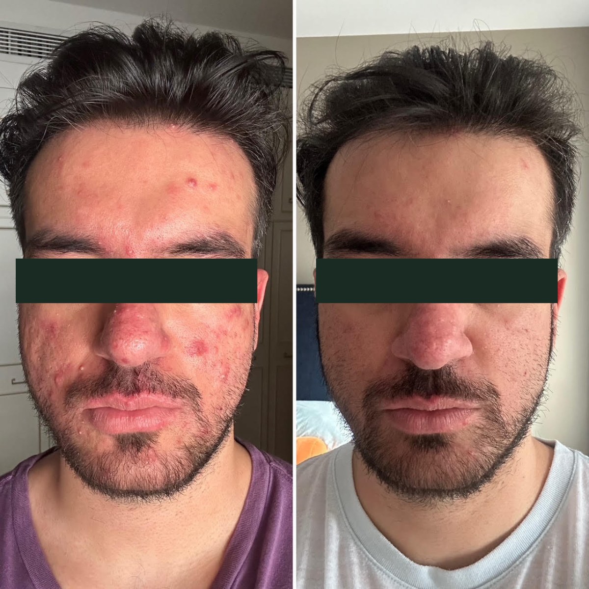 Saif, front-facing before and after, eyes redacted for privacy