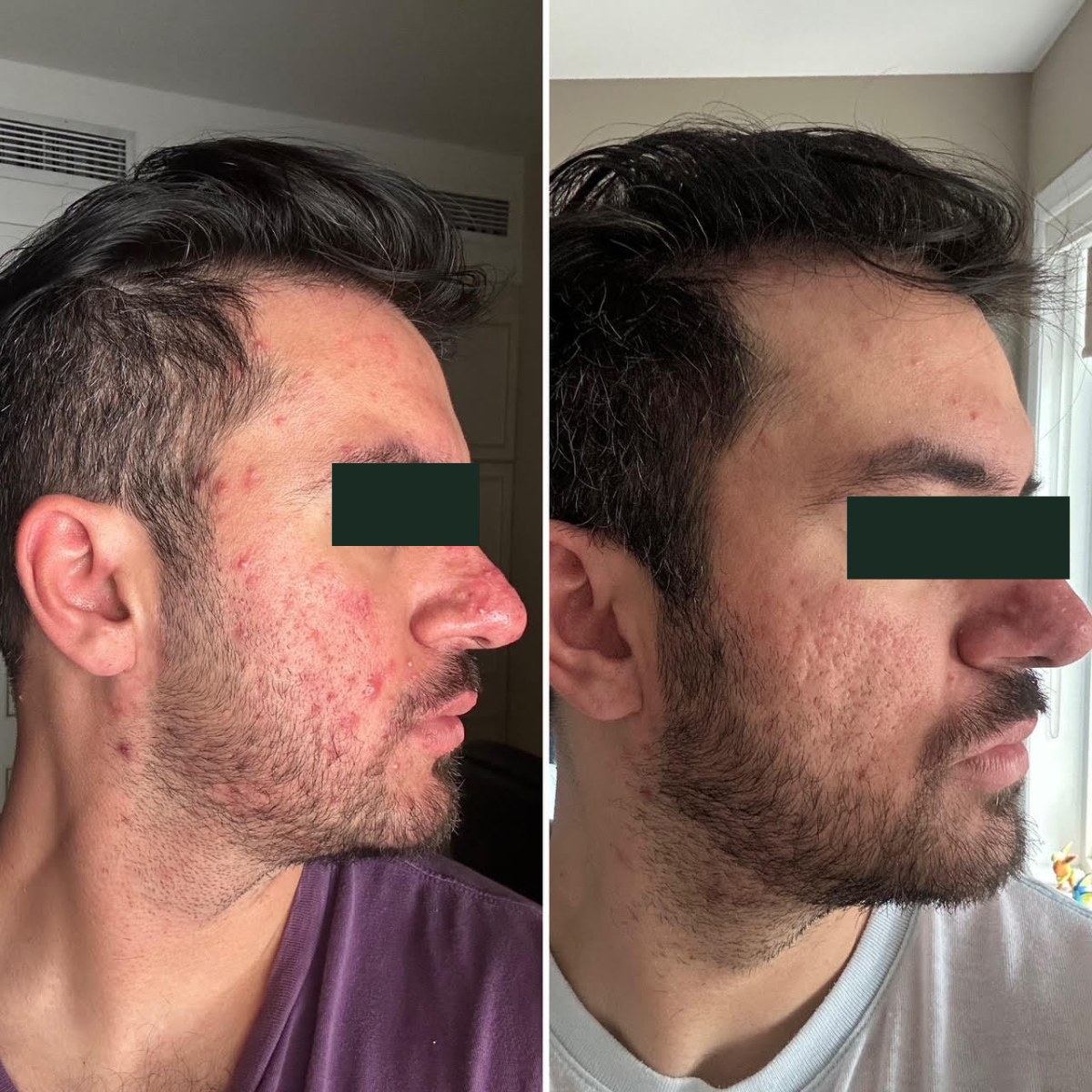 Saif, right-profile before and after, eyes redacted for privacy