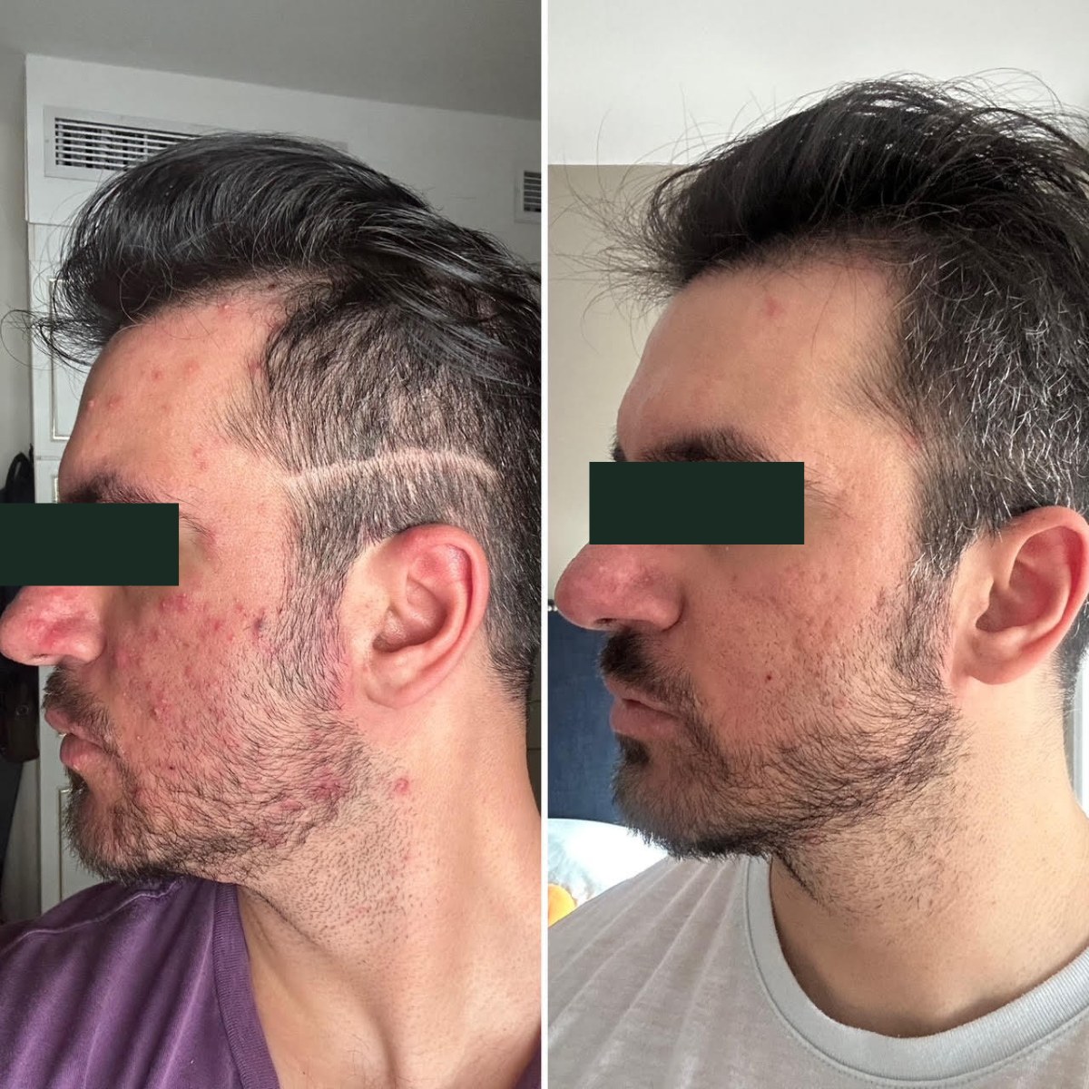 Saif, left-profile before and after, eyes redacted for privacy