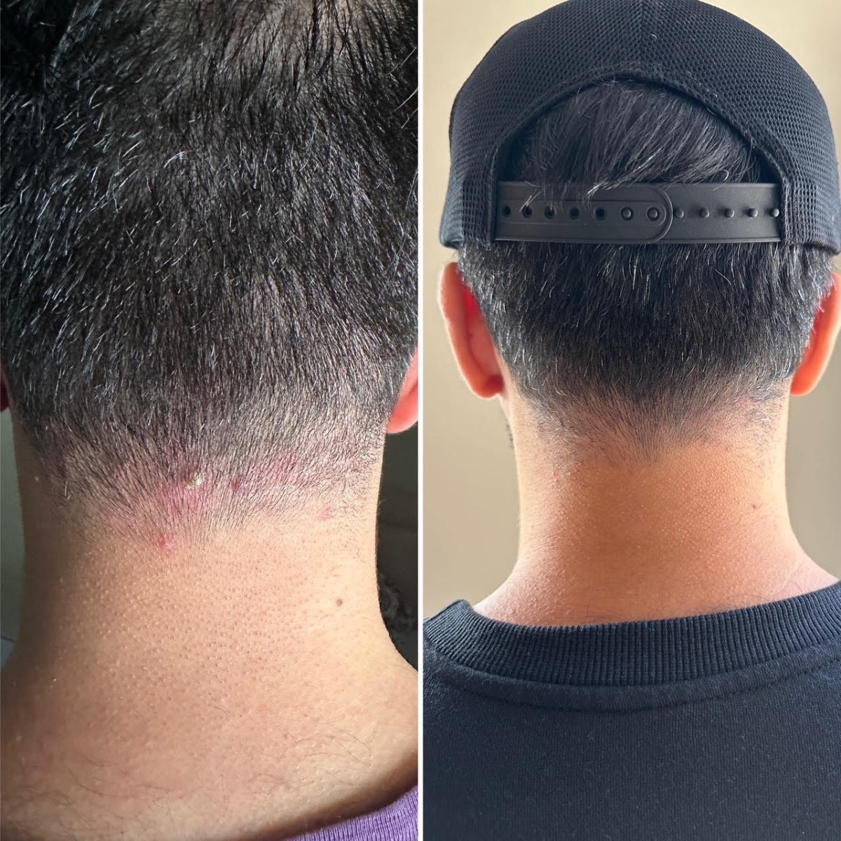 Saif, back-of-neck before and after